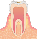 C1 初期の虫歯の状態