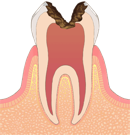 C4 歯根に進行した虫歯